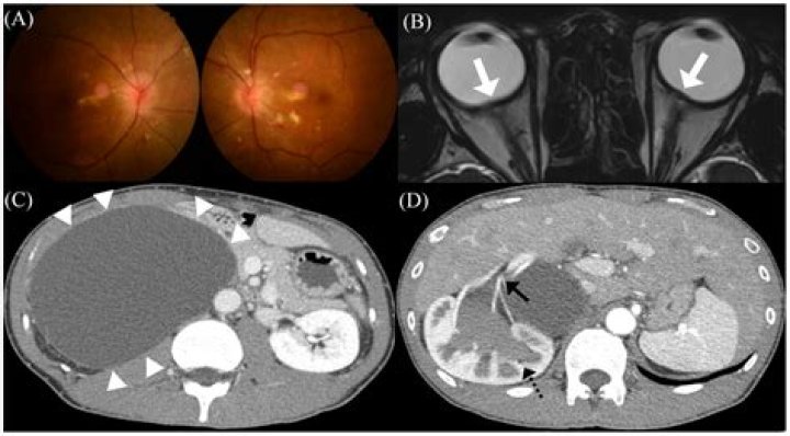 Is pseudotumor cerebri permanent