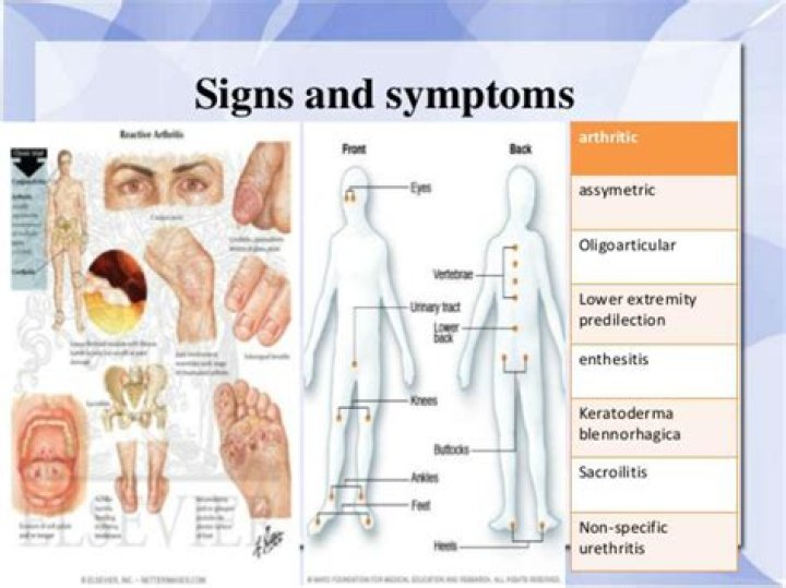 Is Reiters syndrome curable