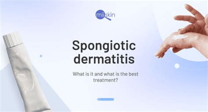 Is Spongiotic dermatitis rare