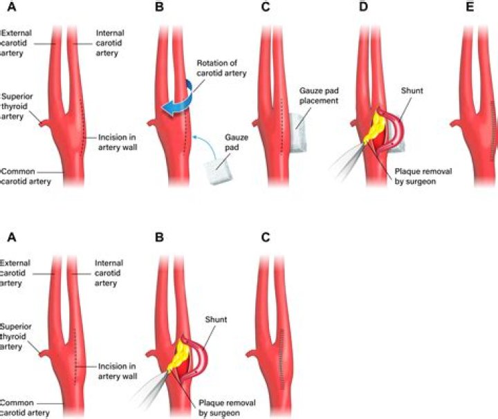 Is the correct CPT code for a pulmonary endarterectomy with embolectomy requiring cardiopulmonary bypass