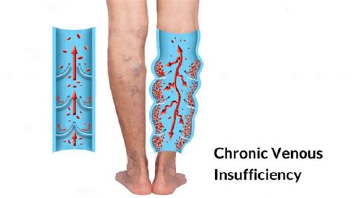 Is venous insufficiency painful