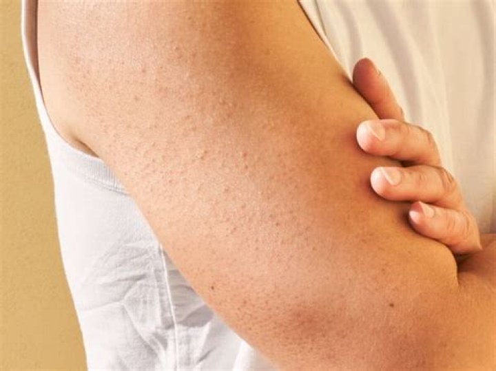¿Por qué se produce la queratosis