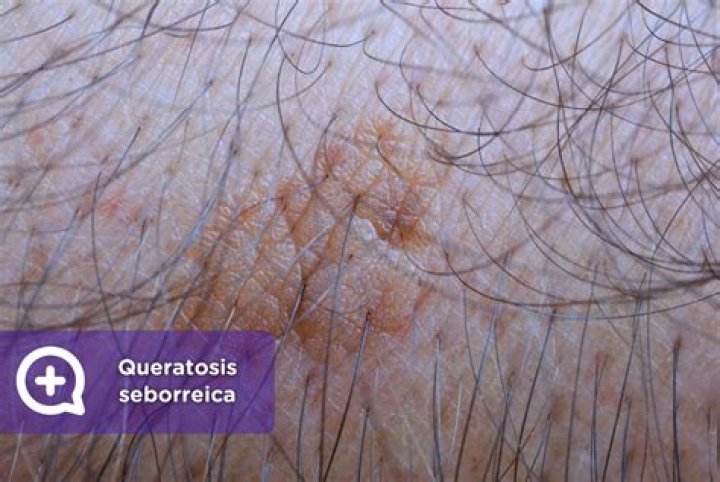 ¿Qué es la queratosis Actinica Hipertrofica