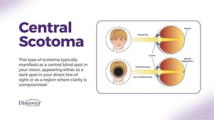 What are blind spots in vision