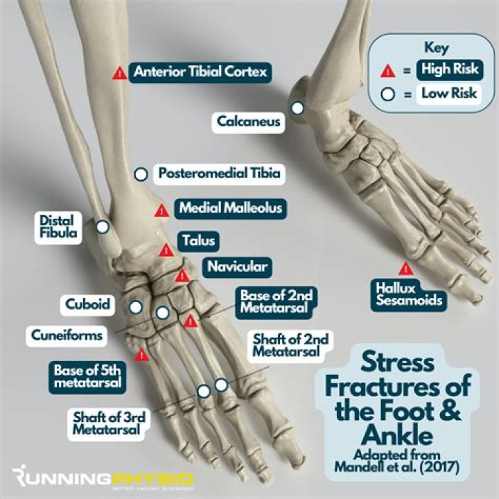 What are external cause codes and how do they relate to fractures