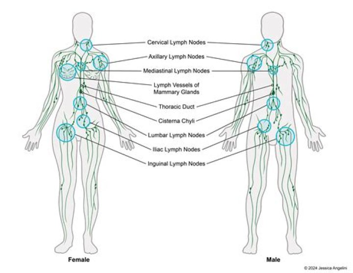 What are nodules in the lymph nodes
