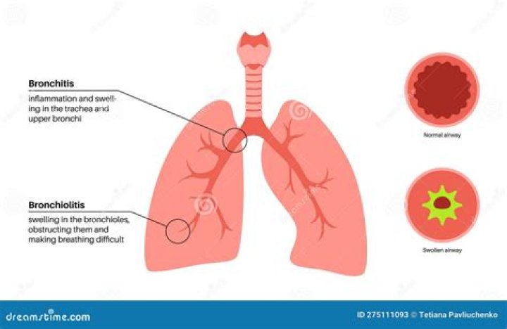 What are the complications of acute bronchitis