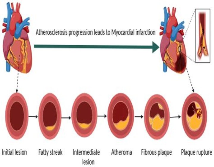 What are the major sites of atheroma formation