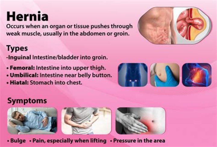 What are the symptoms of incarcerated hernia