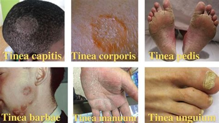 What are the symptoms of tinea capitis