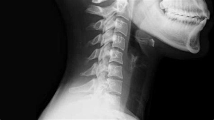 What can a neck X-ray show