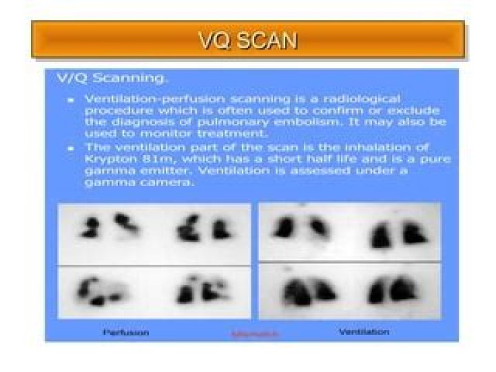What can a VQ scan detect
