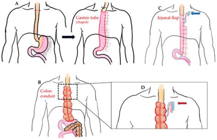What can block the esophagus