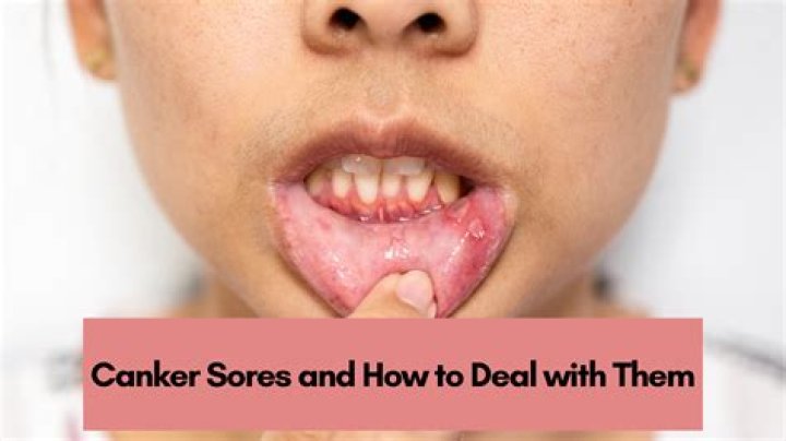 What can I eat with canker sores in my mouth
