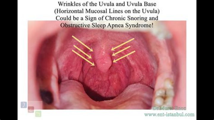 What causes a papilloma on the uvula