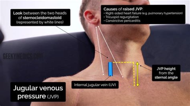 What causes a positive hepatojugular reflux