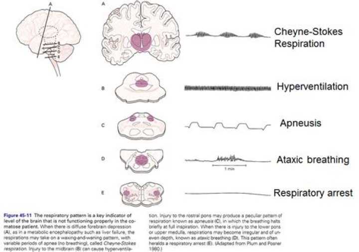 What causes ataxic breathing