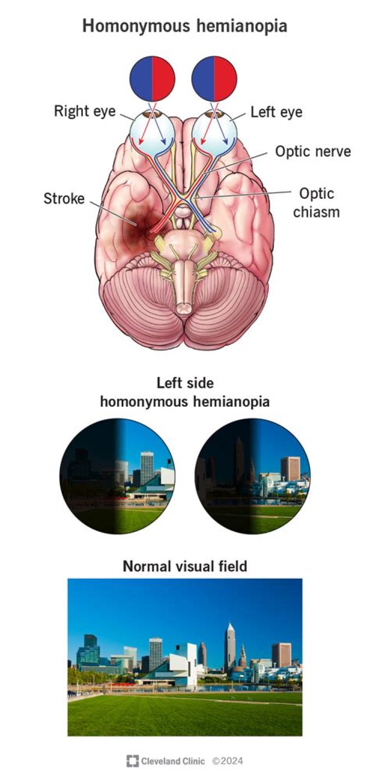 What causes Bitemporal Hemianopsia