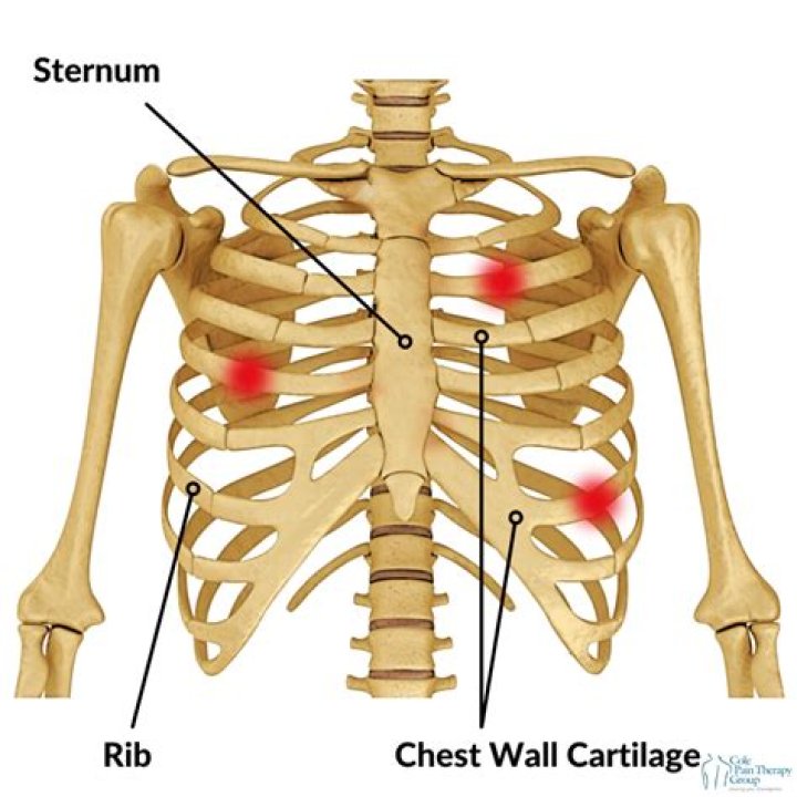 What causes costochondritis to flare up