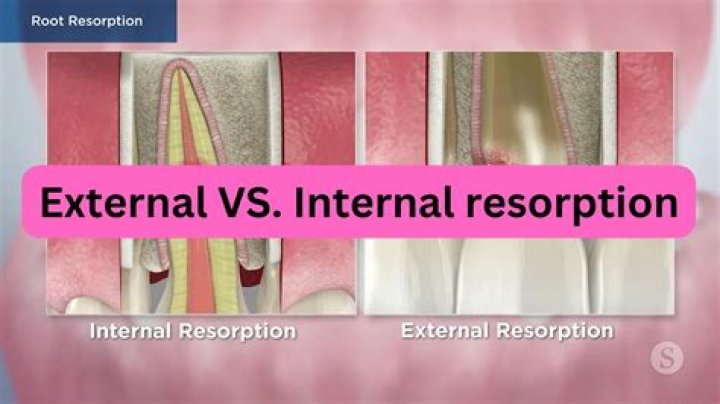 What causes internal resorption of teeth