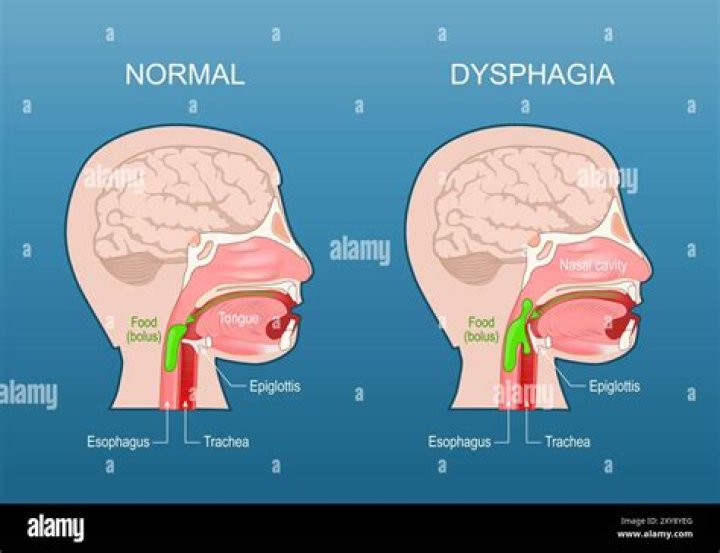 What causes oral dysphagia