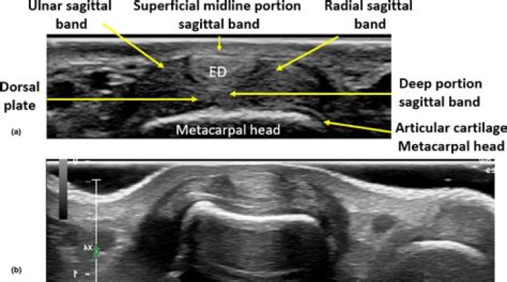 What causes sagittal band rupture