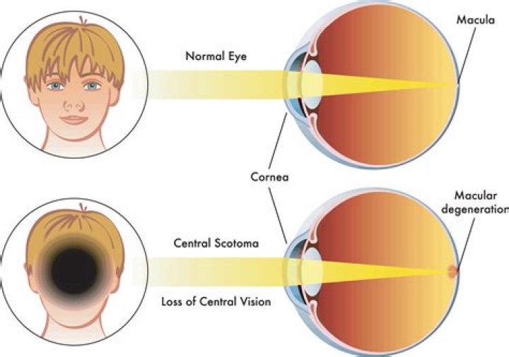 What causes scotoma eye