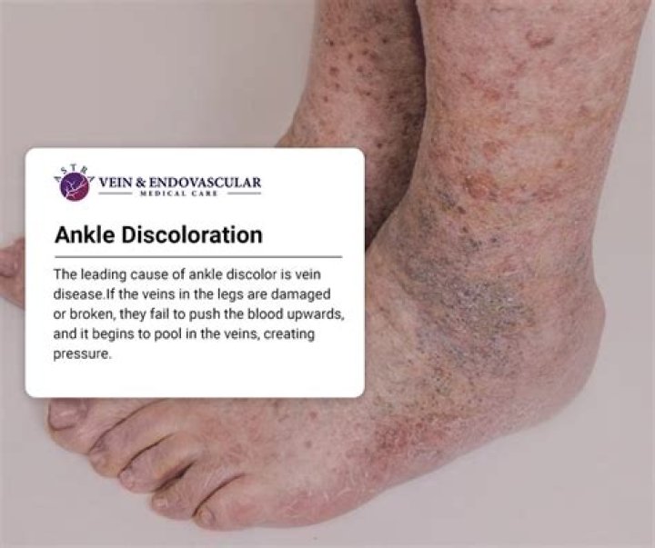What causes skin discoloration on ankles
