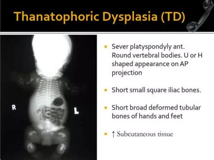 What causes Thanatophoric dysplasia