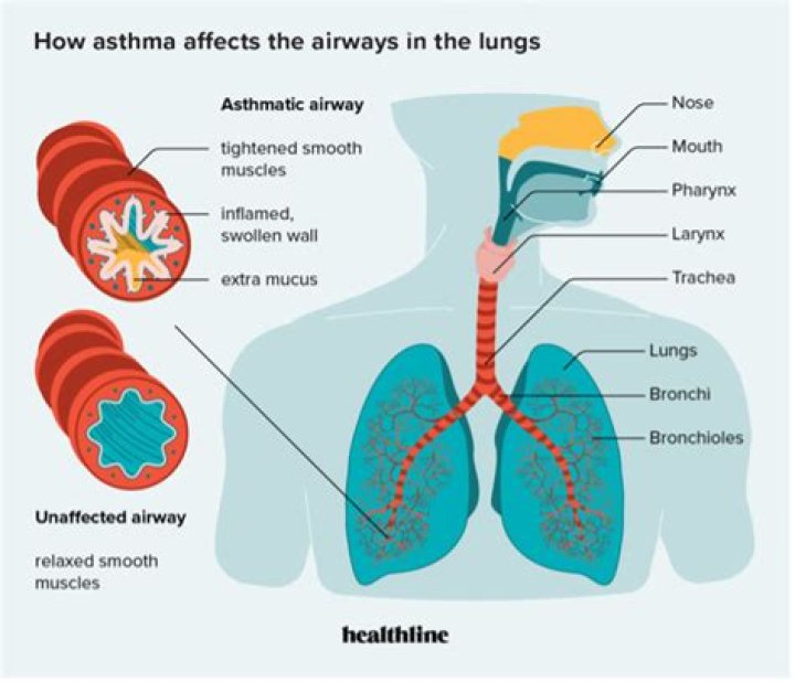 What causes the airways to narrow