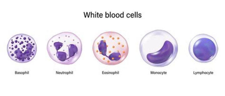 What causes white blood cells in urine but no infection