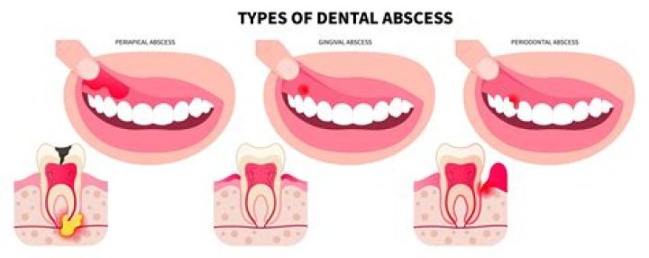 What Colour is a gum abscess