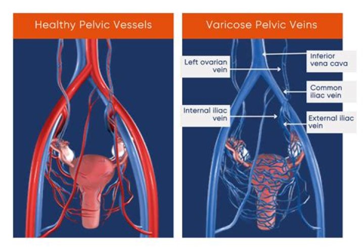 What condition is caused by Varicosities of the rectal veins