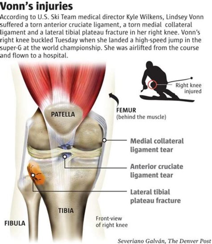 What did Lindsey Vonn do to her knee