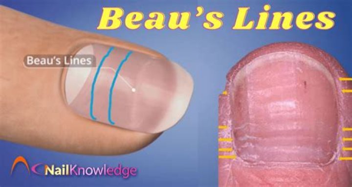 What do Beaus lines in nails look like