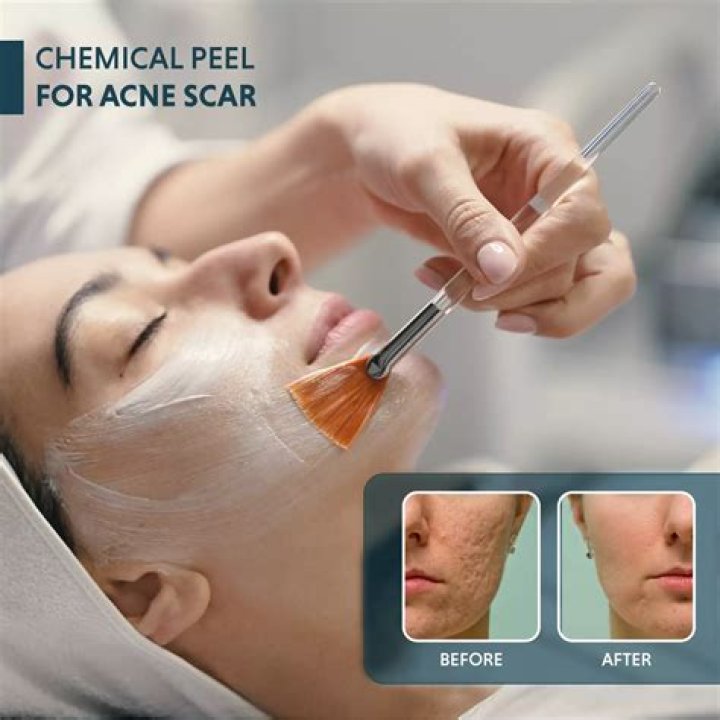 What do exfoliating peels do