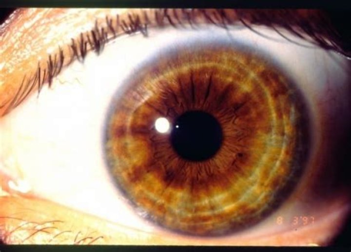 What do rings in the iris mean