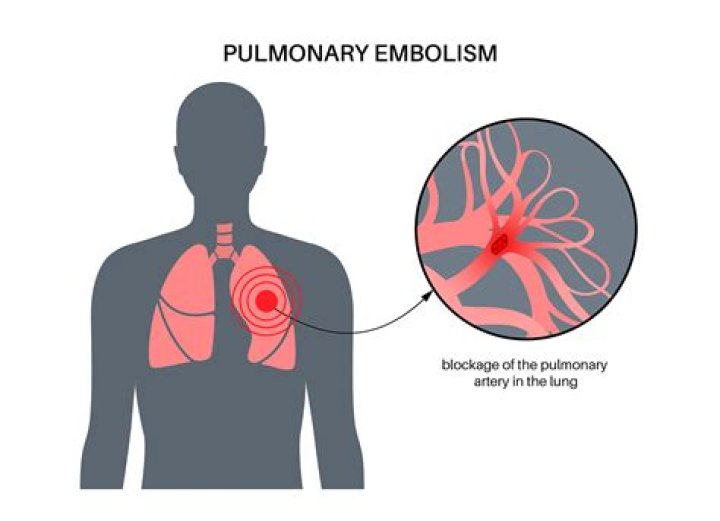 What do you do if someone has a pulmonary embolism