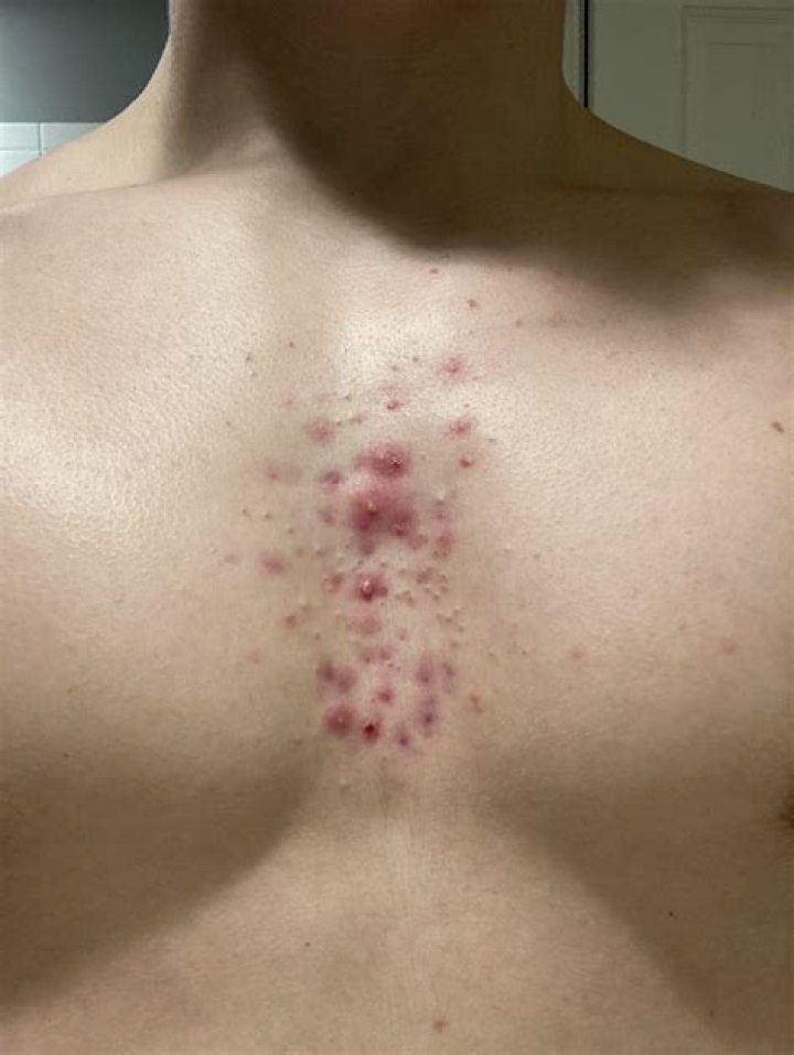 What do you put on Acne Mechanica