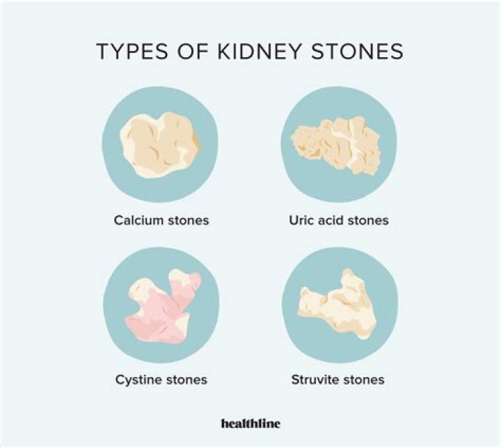 What does a bile duct stone feel like