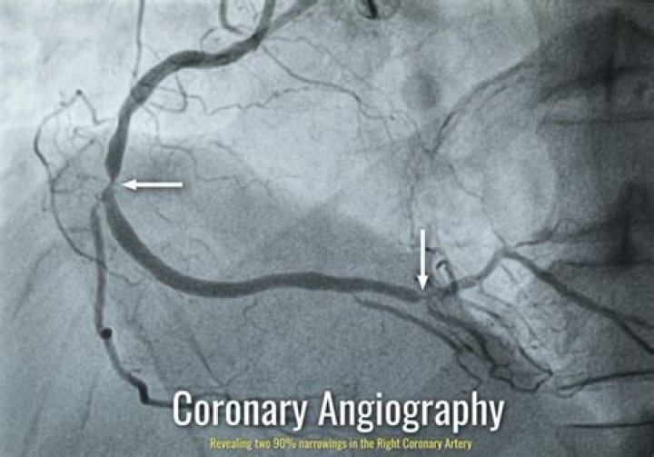 What does a coronary angiogram show
