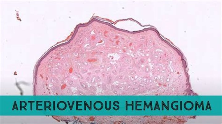 What does a hemangioma look like when it first appears