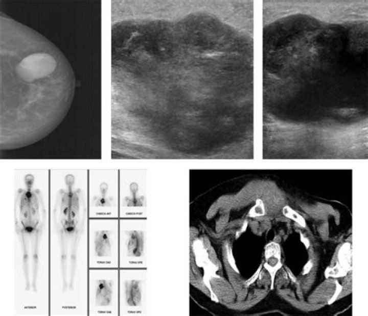 What does a phyllodes tumor look like