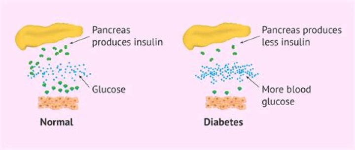 What does diabetes do to bones