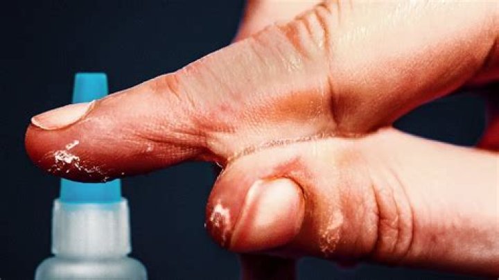 What does glue do to your skin