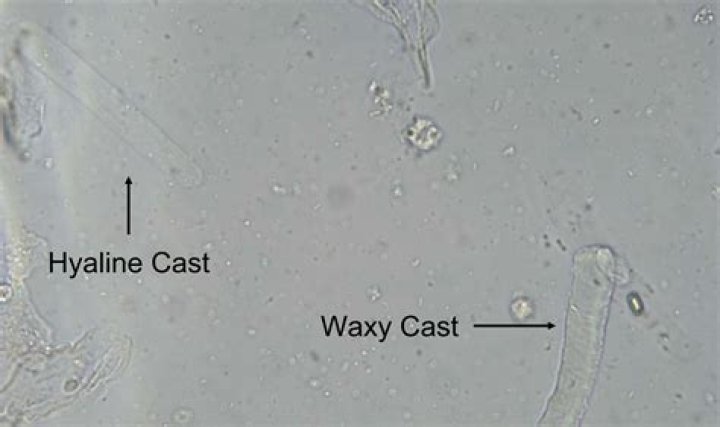 What does it mean to have casts in your urine