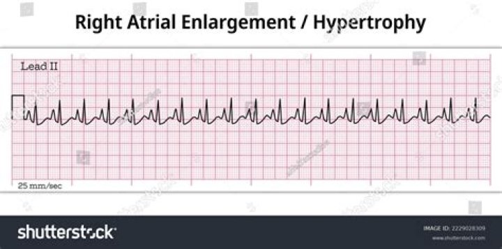 What does it mean to have right atrial enlargement