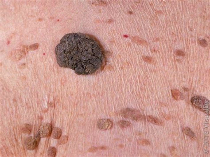 What does skin keratosis look like