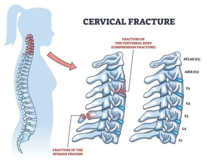 What does the first cervical vertebra lack