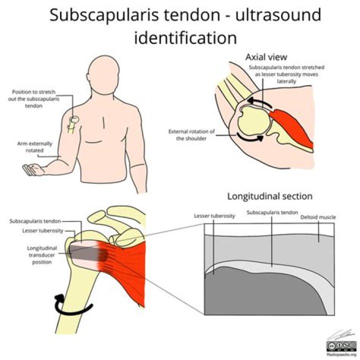 What does the subscapularis tendon do